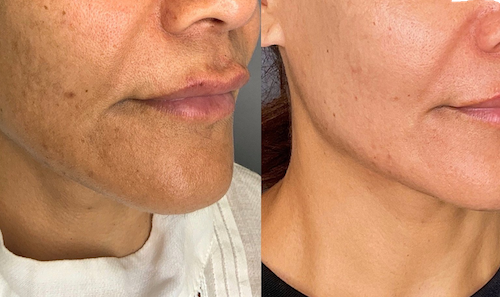 melasma removal before after mississauga oakville